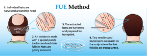 FUE-Hair-Transplant