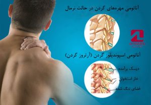 آرتروز گردن