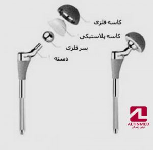 تعویض مفصل ران