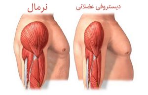 تحلیل عضلانی