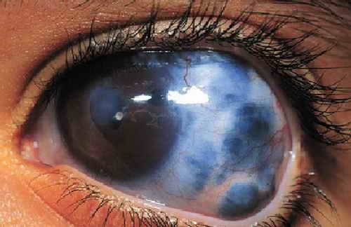 بیماری آب‌ سیاه یا گلوکوما glaucoma علل و علائم